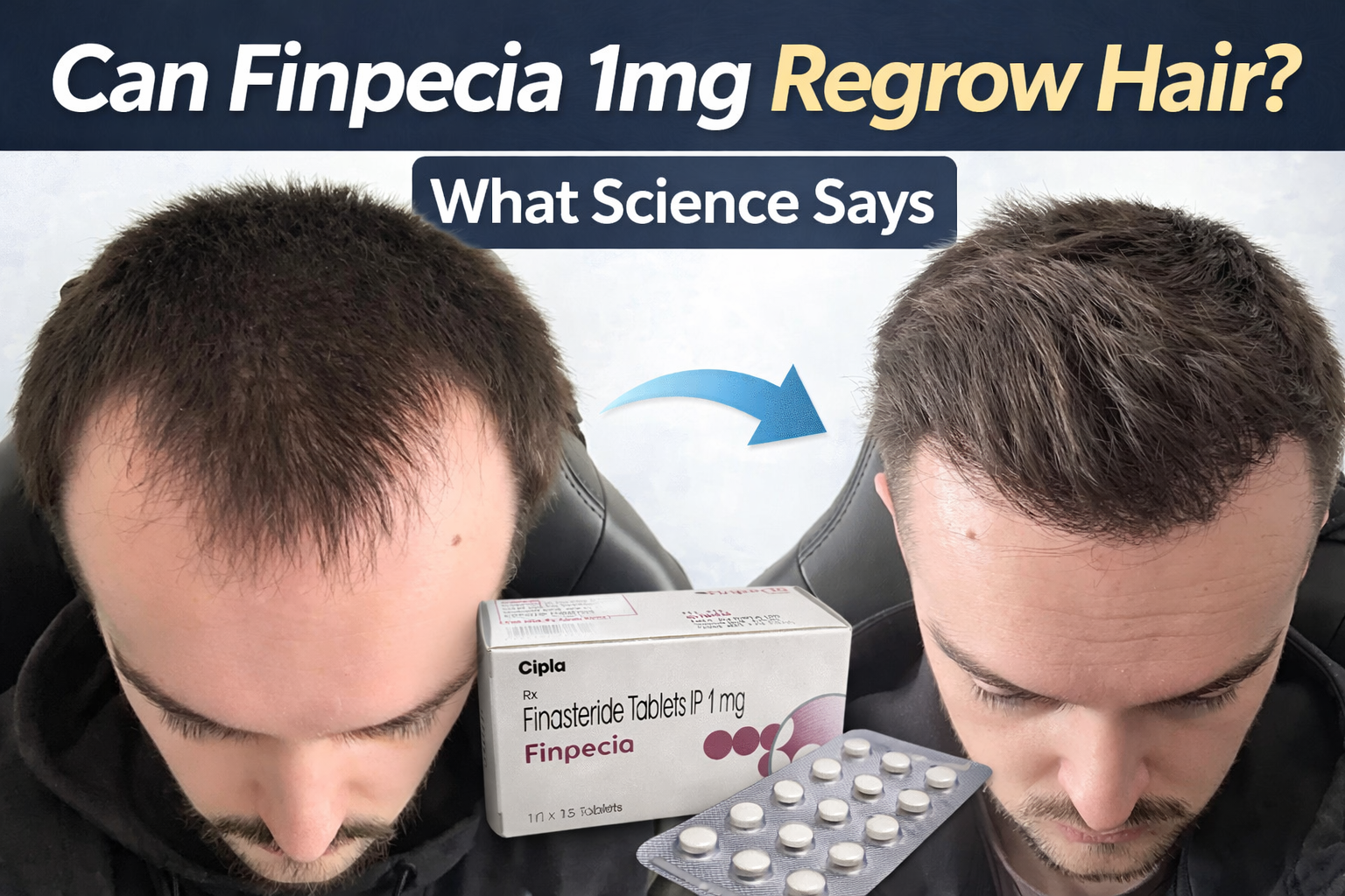Can Finpecia 1mg Regrow Hair? What Science Really Says