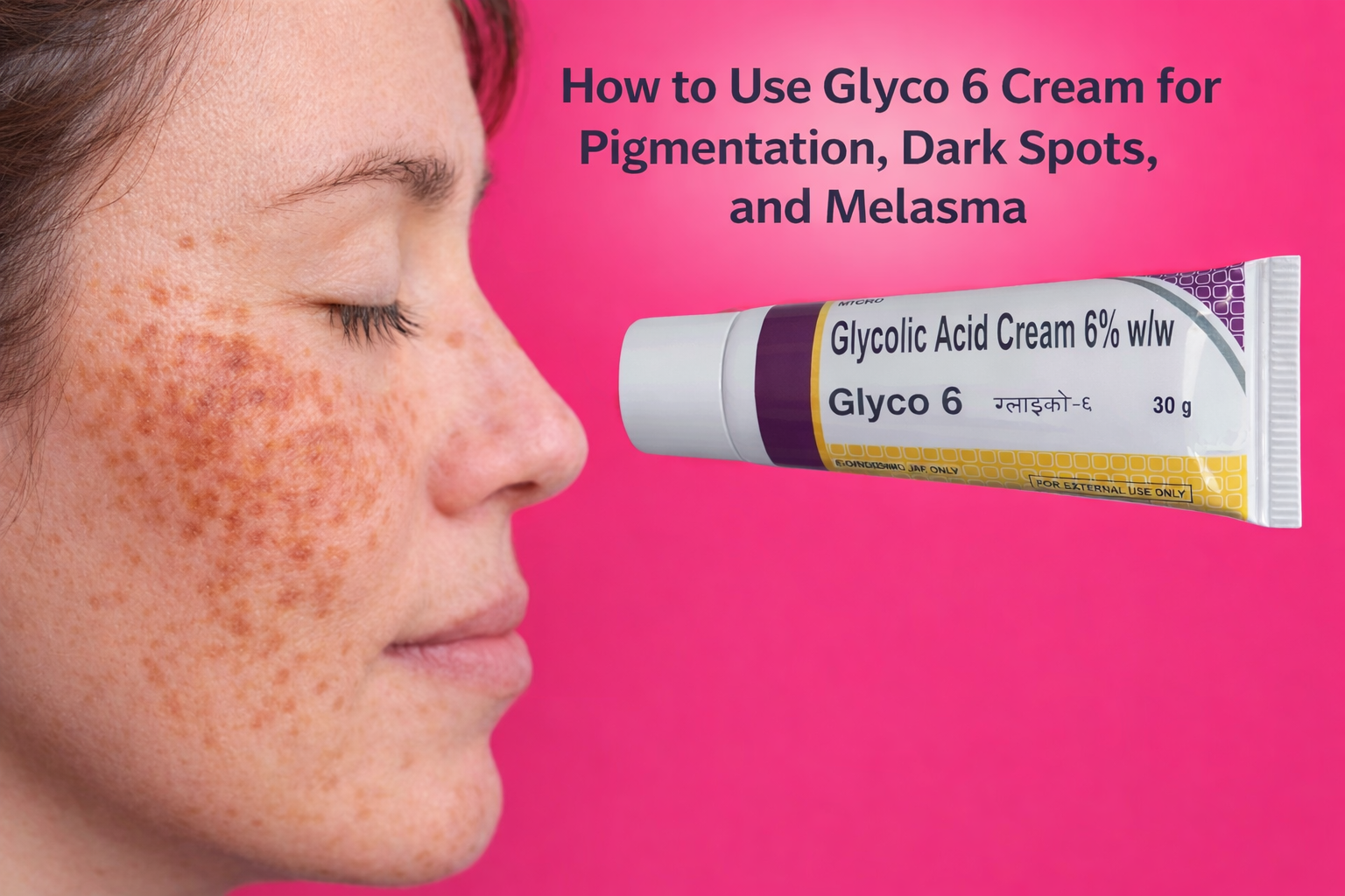 How to Use Glyco 6 Cream for Pigmentation, Dark Spots, and Melasma