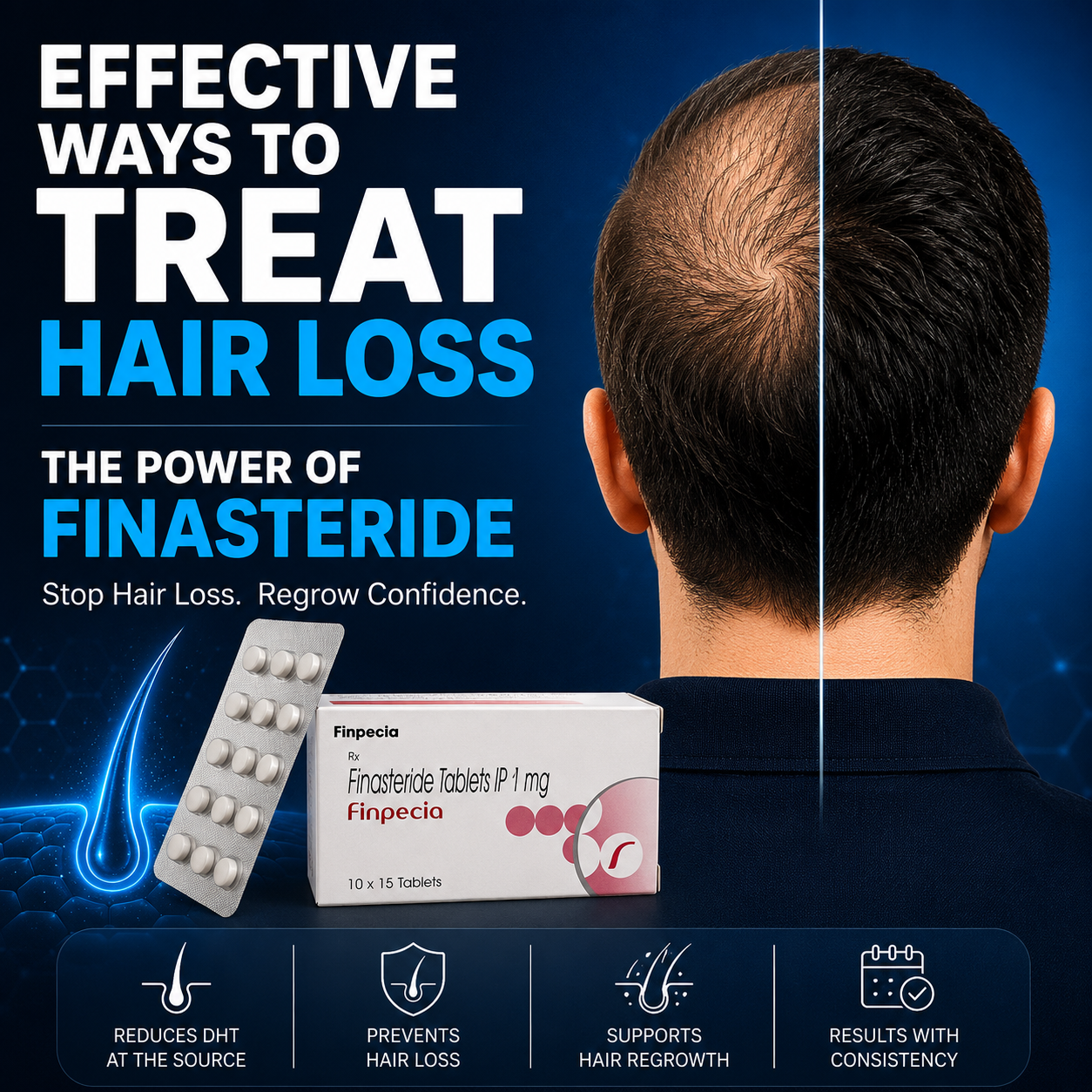 Effective Ways to Treat Hair Loss: Why Finasteride Remains One of the Best Options